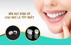 Các Loại Răng Sứ Tốt Nhất Hiện Nay 