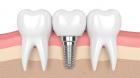 Cấy Ghép Implant Những Điều Cần Lưu Ý