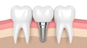 Cấy Ghép Implant Những Điều Cần Lưu Ý